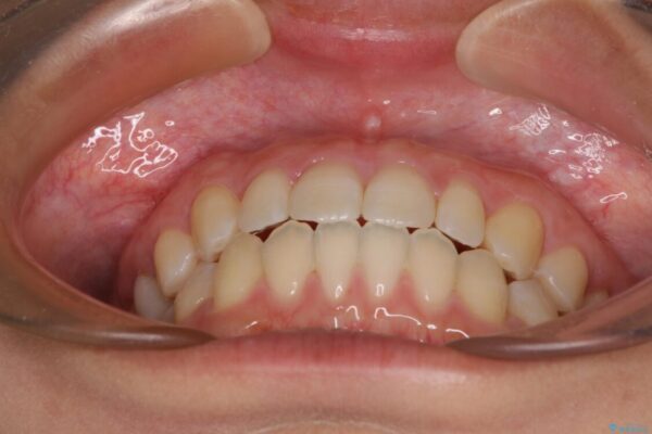 隙間だらけの歯列　インビザラインで改善 治療後画像