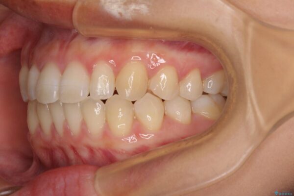 隙間だらけの歯列　インビザラインで改善 治療後画像