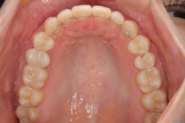 隙間だらけの歯列　インビザラインで改善 治療後画像