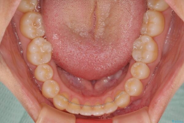 隙間だらけの歯列　インビザラインで改善 治療後画像