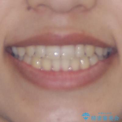 隙間だらけの歯列　インビザラインで改善 アフター