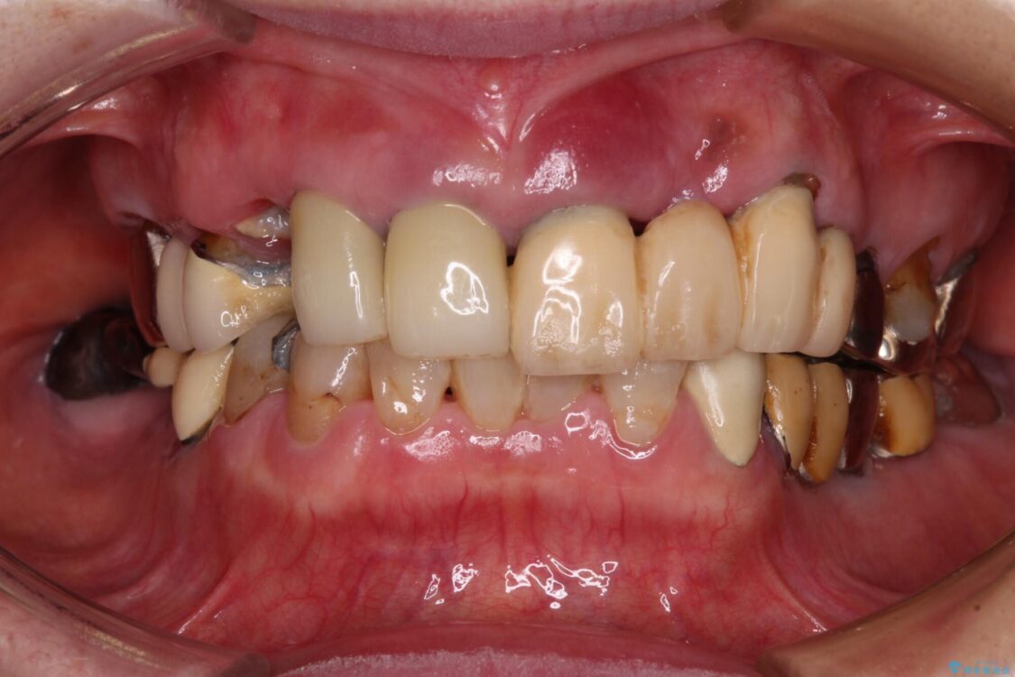 前歯をきれいにしたい　インプラントや部分矯正を用いた総合歯科治療 治療前