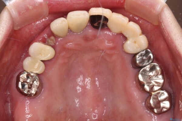 前歯をきれいにしたい　インプラントや部分矯正を用いた総合歯科治療 治療前画像