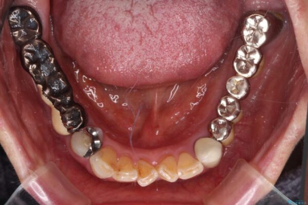 前歯をきれいにしたい　インプラントや部分矯正を用いた総合歯科治療 治療前画像