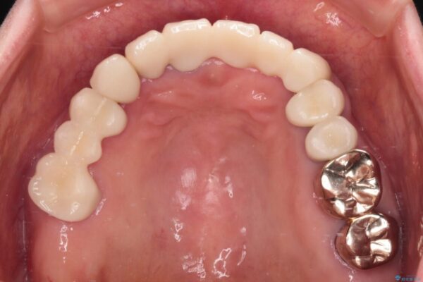 前歯をきれいにしたい　インプラントや部分矯正を用いた総合歯科治療 治療後画像