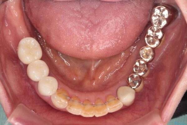 前歯をきれいにしたい　インプラントや部分矯正を用いた総合歯科治療 治療後画像