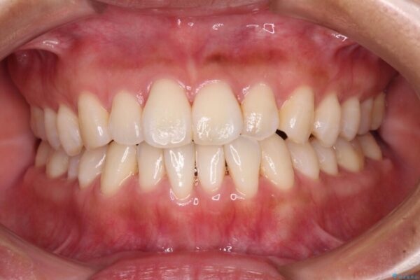 【モニター】前歯のデコボコをインビザラインで改善 治療前画像