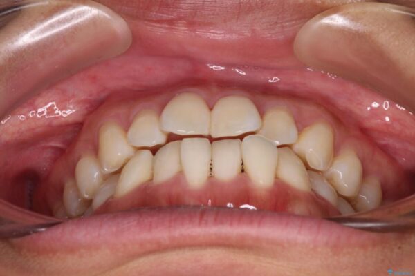 【モニター】前歯のデコボコをインビザラインで改善 治療前画像