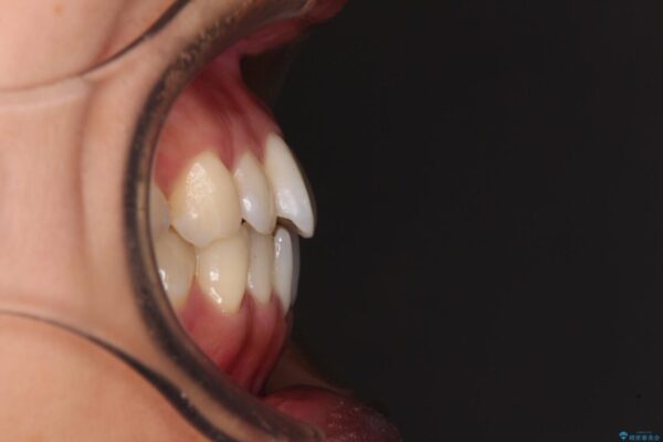 【モニター】前歯のデコボコをインビザラインで改善 治療前画像