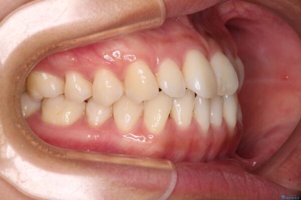 【モニター】前歯のデコボコをインビザラインで改善 治療前画像