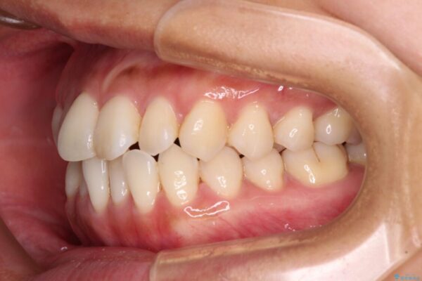 【モニター】前歯のデコボコをインビザラインで改善 治療前画像