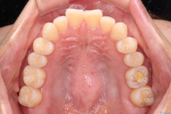 【モニター】前歯のデコボコをインビザラインで改善 治療前画像