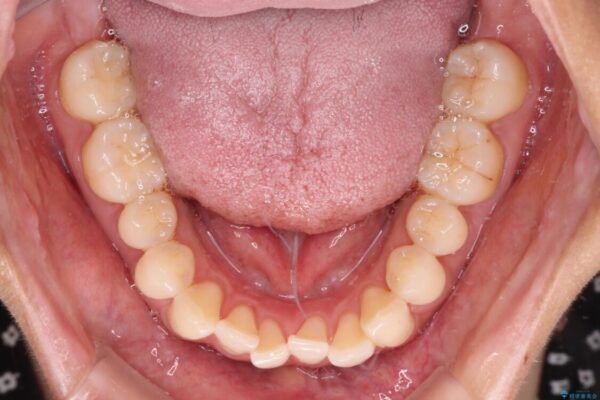 【モニター】前歯のデコボコをインビザラインで改善 治療前画像