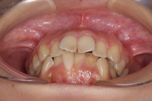 デコボコと口元の突出感　ハーフリンガルでの抜歯矯正 治療前画像