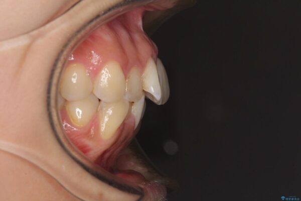 デコボコと口元の突出感　ハーフリンガルでの抜歯矯正 治療前画像