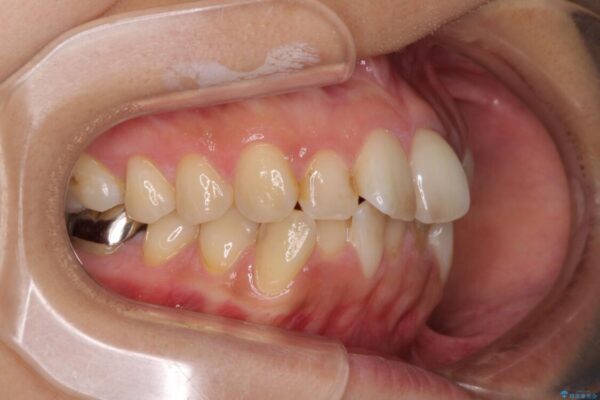 デコボコと口元の突出感　ハーフリンガルでの抜歯矯正 治療前画像