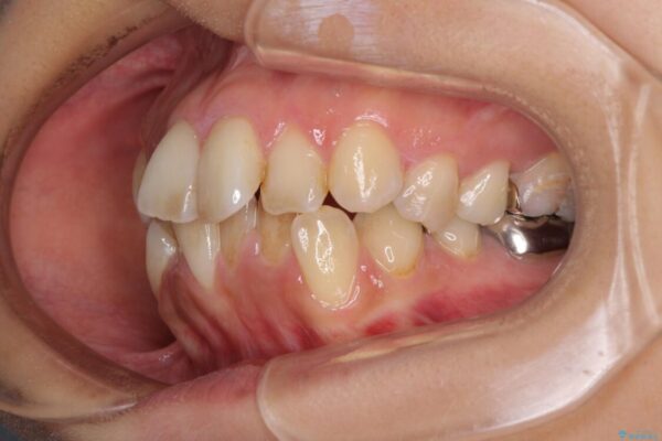 デコボコと口元の突出感　ハーフリンガルでの抜歯矯正 治療前画像