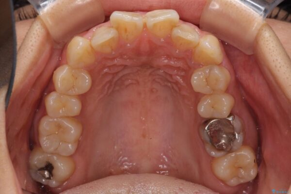 デコボコと口元の突出感　ハーフリンガルでの抜歯矯正 治療前画像