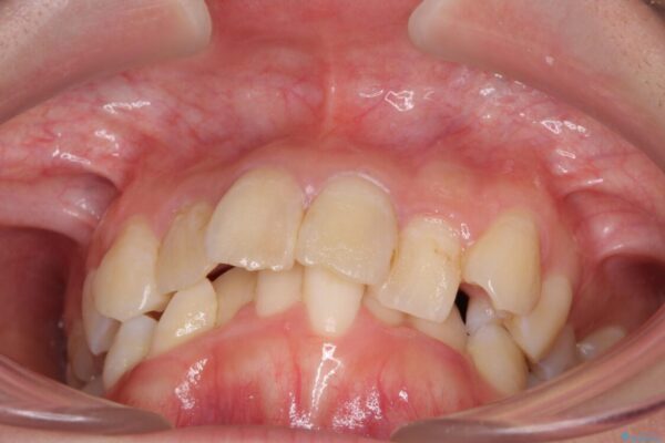 デコボコと深い咬み合わせ　ワイヤー装置での抜歯矯正 治療前画像