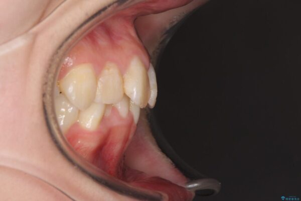 デコボコと深い咬み合わせ　ワイヤー装置での抜歯矯正 治療前画像