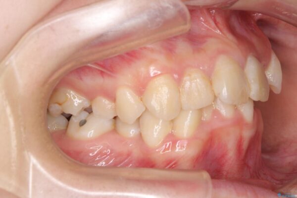 デコボコと深い咬み合わせ　ワイヤー装置での抜歯矯正 治療前画像