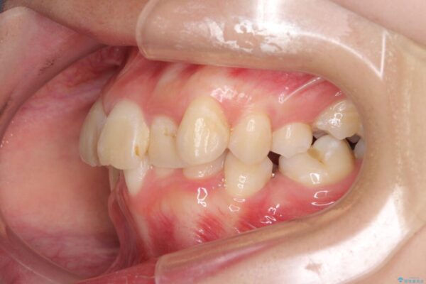 デコボコと深い咬み合わせ　ワイヤー装置での抜歯矯正 治療前画像