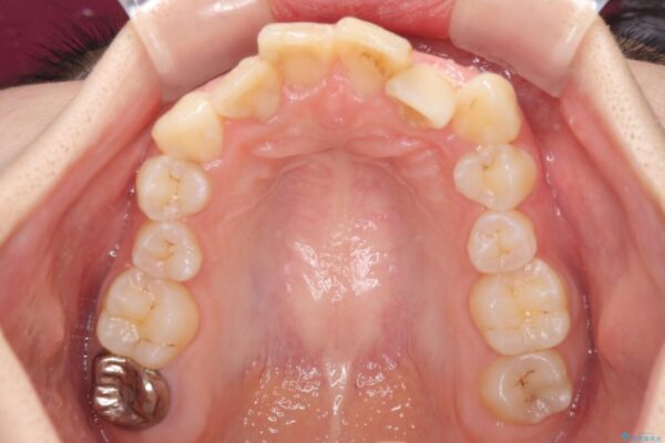 デコボコと深い咬み合わせ　ワイヤー装置での抜歯矯正 治療前画像