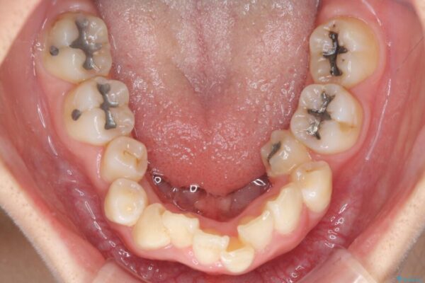 デコボコと深い咬み合わせ　ワイヤー装置での抜歯矯正 治療前画像