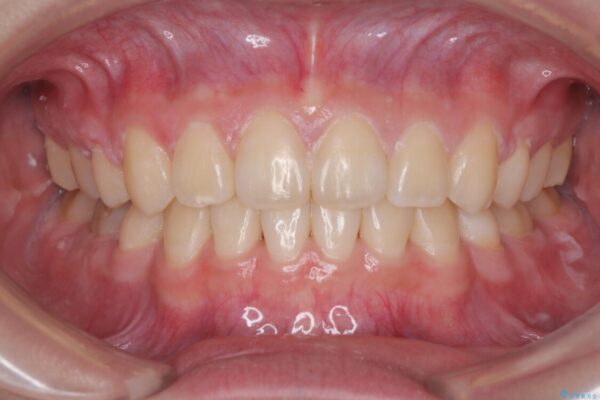 転勤でも安心して治療継続　抜歯スペース閉鎖と深い噛み合わせ改善のワイヤー矯正 アフター