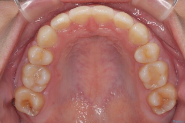転勤でも安心して治療継続　抜歯スペース閉鎖と深い噛み合わせ改善のワイヤー矯正 治療後画像