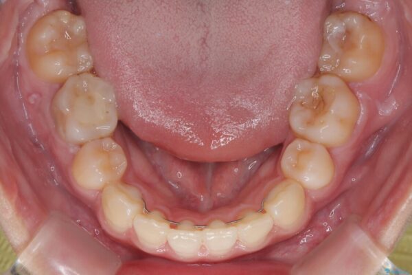 転勤でも安心して治療継続　抜歯スペース閉鎖と深い噛み合わせ改善のワイヤー矯正 治療後画像