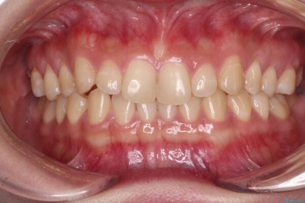 治療途中の奥歯と矯正治療の後戻り　インビザライン・ライトによる矯正治療 治療前画像