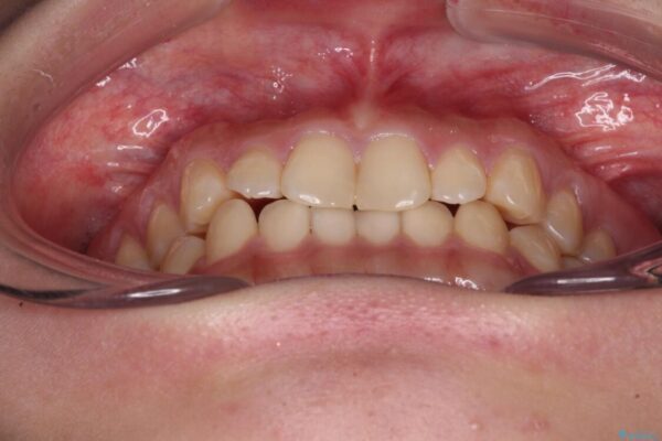 治療途中の奥歯と矯正治療の後戻り　インビザライン・ライトによる矯正治療 治療前画像