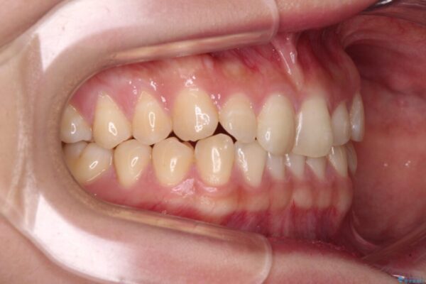 治療途中の奥歯と矯正治療の後戻り　インビザライン・ライトによる矯正治療 治療前画像