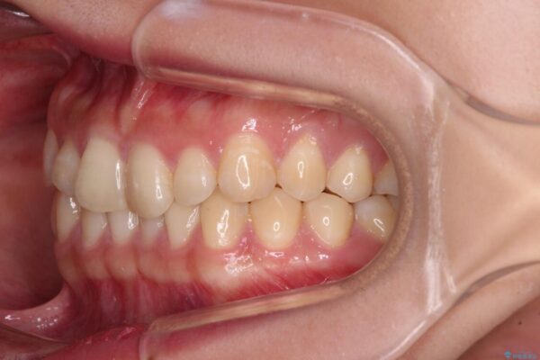 治療途中の奥歯と矯正治療の後戻り　インビザライン・ライトによる矯正治療 治療前画像