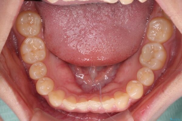 治療途中の奥歯と矯正治療の後戻り　インビザライン・ライトによる矯正治療 治療前画像