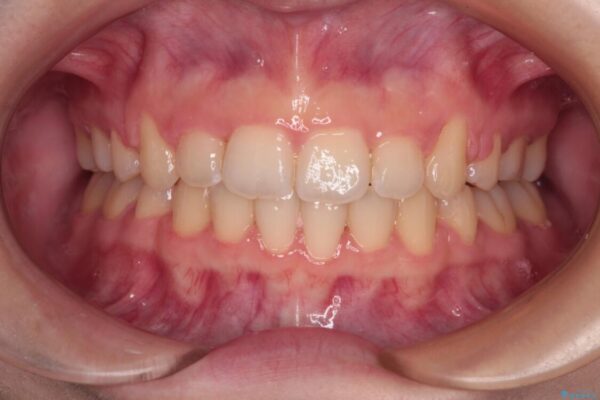 【モニター】口が閉じられない　ワイヤー装置での抜歯矯正 治療後画像
