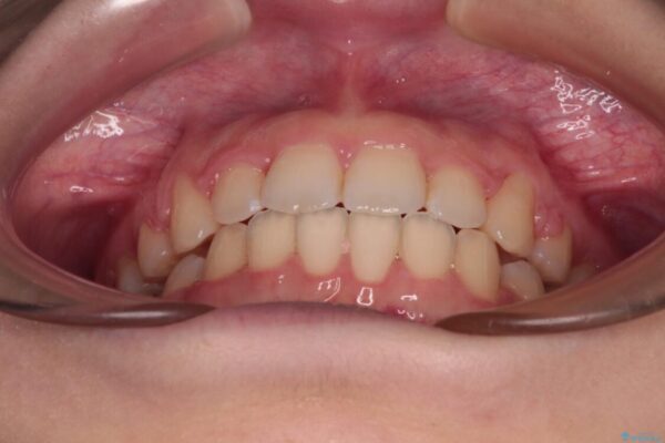【モニター】口が閉じられない　ワイヤー装置での抜歯矯正 治療後画像