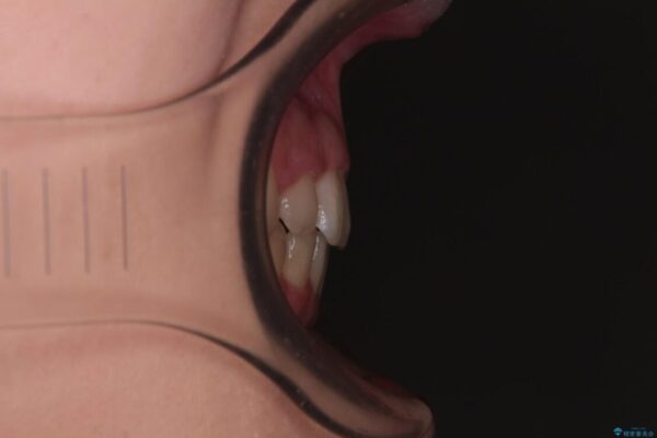 【モニター】口が閉じられない　ワイヤー装置での抜歯矯正 治療後画像