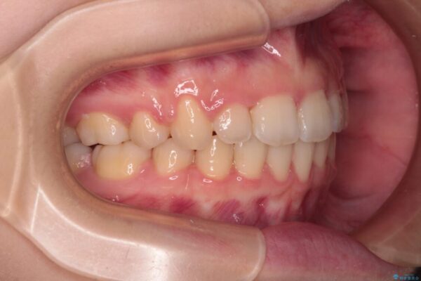 【モニター】口が閉じられない　ワイヤー装置での抜歯矯正 治療後画像