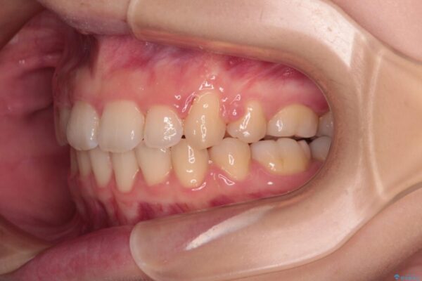 【モニター】口が閉じられない　ワイヤー装置での抜歯矯正 治療後画像