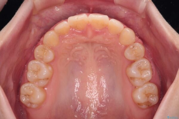 【モニター】口が閉じられない　ワイヤー装置での抜歯矯正 治療後画像