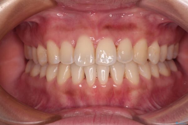 【モニター】前歯のデコボコをインビザラインで改善 治療後画像