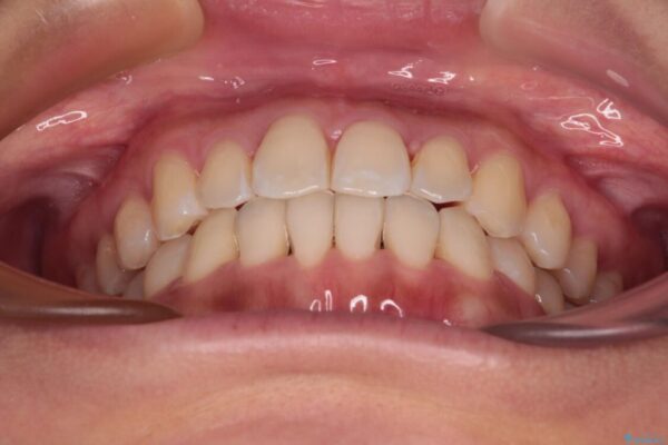 【モニター】前歯のデコボコをインビザラインで改善 治療後画像