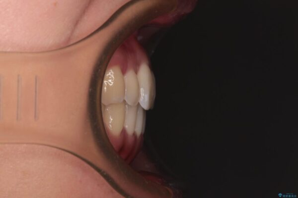 【モニター】前歯のデコボコをインビザラインで改善 治療後画像