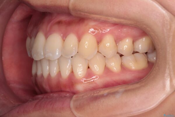 【モニター】前歯のデコボコをインビザラインで改善 治療後画像