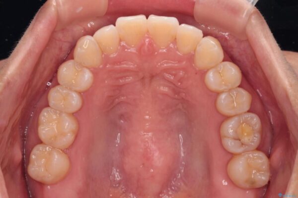 【モニター】前歯のデコボコをインビザラインで改善 治療後画像