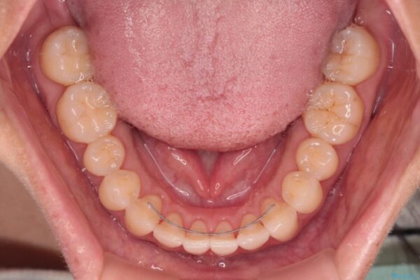 【モニター】前歯のデコボコをインビザラインで改善 治療後画像