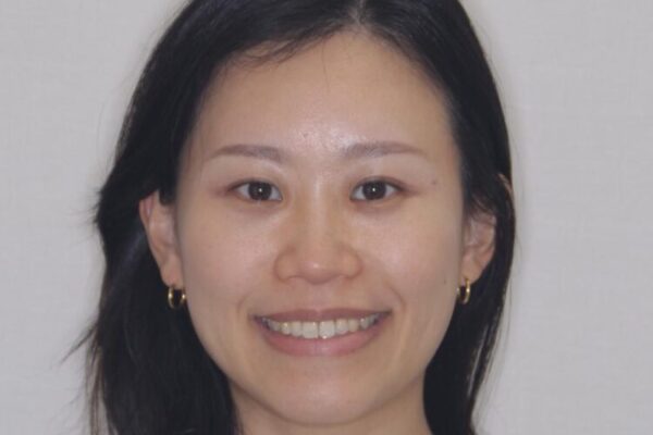 【モニター】前歯のデコボコをインビザラインで改善 治療後画像