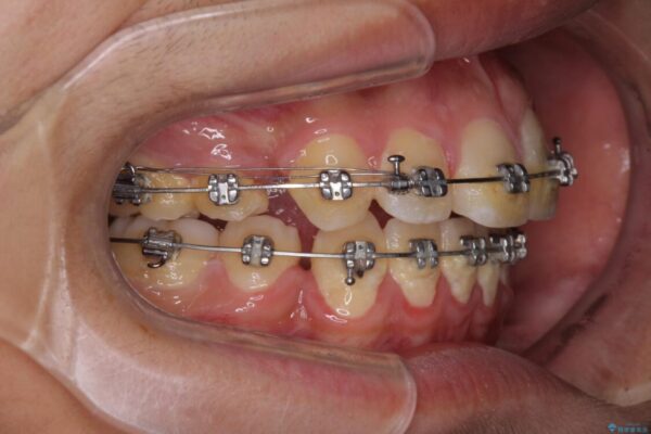 膨らんだ口元　ワイヤー装置での抜歯矯正 治療途中画像